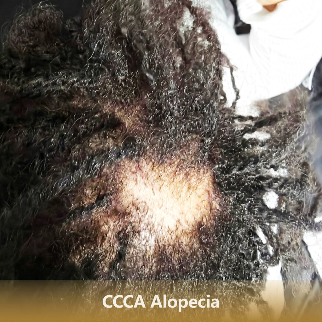 Home 1 CCCA Alopecia 1 1024x1024